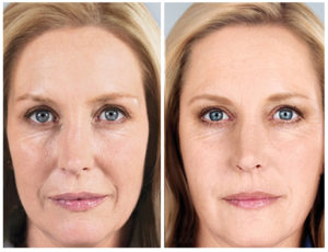 Sculptra Dallas before and after